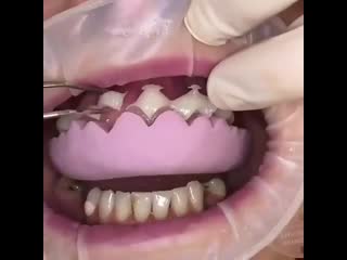 Реставрация зубов фотополимерами