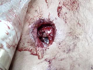 Sucking chest wound 1st warning!!! sensitive images!!! academic purposes only