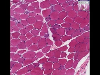 Muscle, skeletal muscular dystrophy