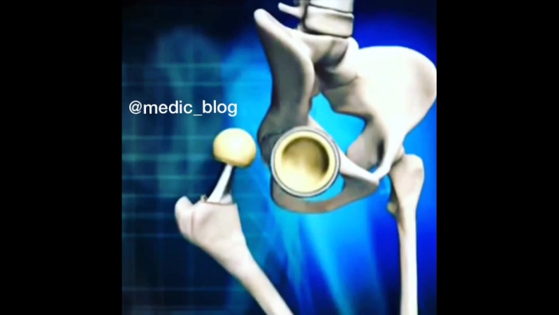 Протезирование тазобедренного сустава