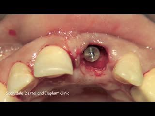 Anterior implant with grafting scarsdale dental