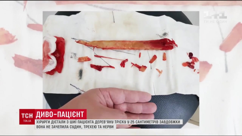 Диво пацієнт хірурги прооперували чоловіка, у шиї якого застрягла 25 сантиметрова тріска