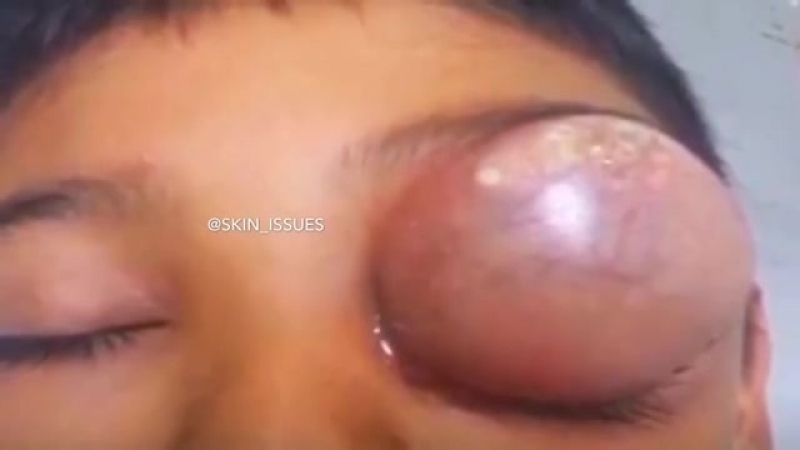 Абсцесс 😱 а твои друзья уже видели такое?