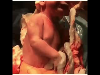 Кесарево сечение