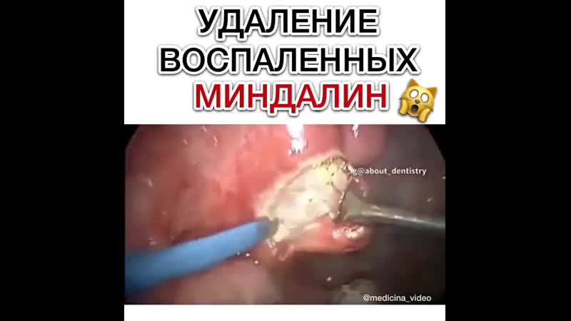 🔪удаление миндалин