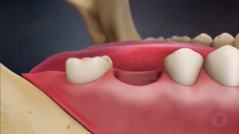 Почему имплант безопаснее других видов протезирования