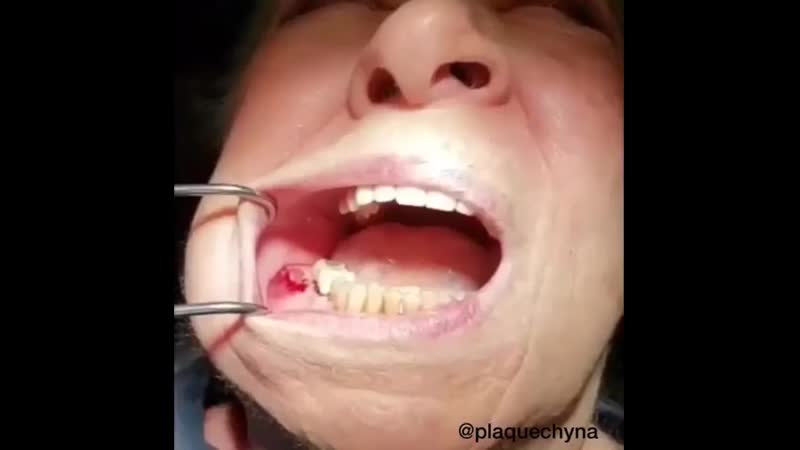 Вскрытие абсцесса