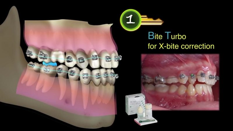 Bite bit bitten перевод. Окклюзионные накладки в ортодонтии. Окклюзионные накладки брекеты. Накладки на зубы ортодонтия. Накусочные пломбы в ортодонтии.