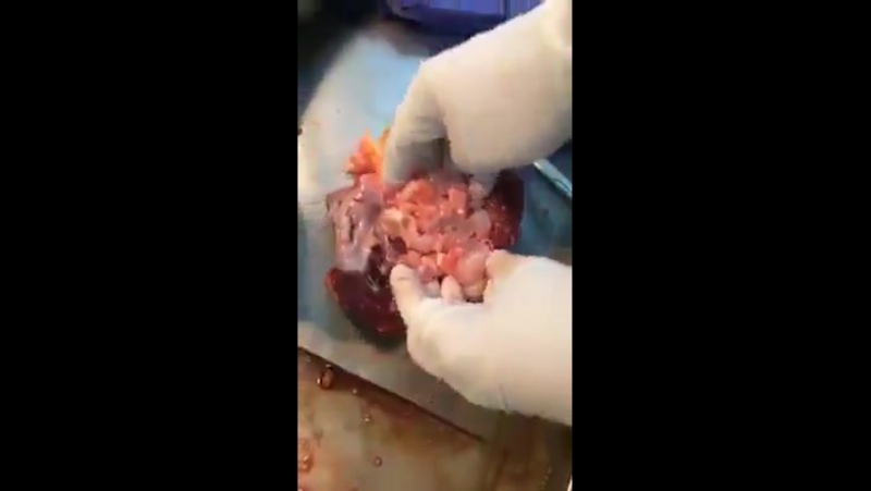 Эхинококковые кисты в сердце