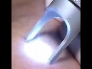 Лазерное удаление вен