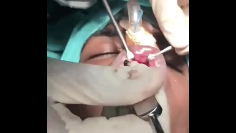 Ортогнатическая медицина передняя верхнечелюстная остеотомия