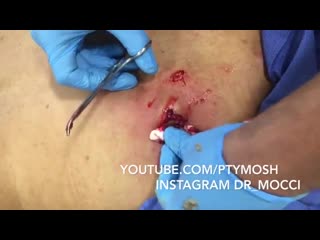 Massive cyst explosion dr pimple popper