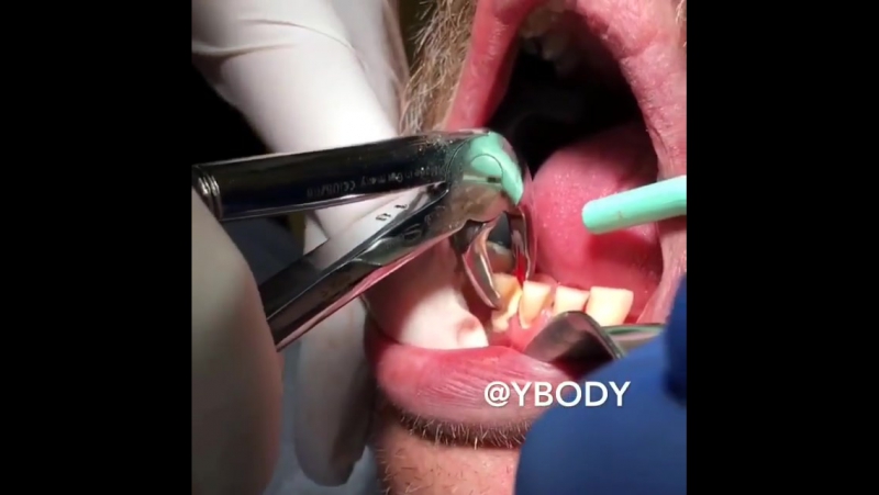 Экстирпация зуба