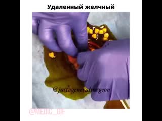 Удаление желчного