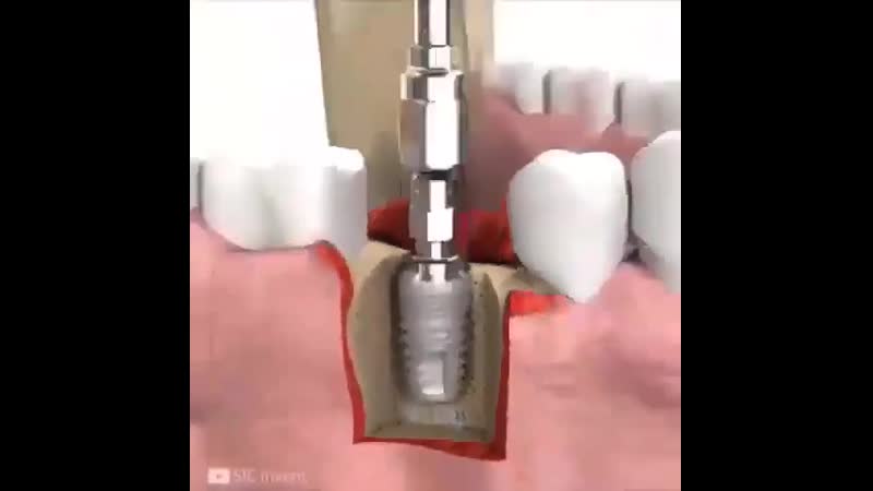Детальная имплантация зуба