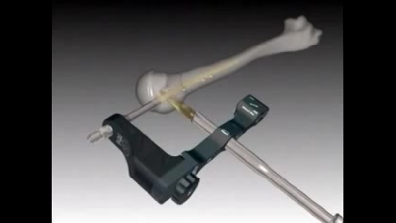 Интрамедуллярный остеосинтез плечевой кости