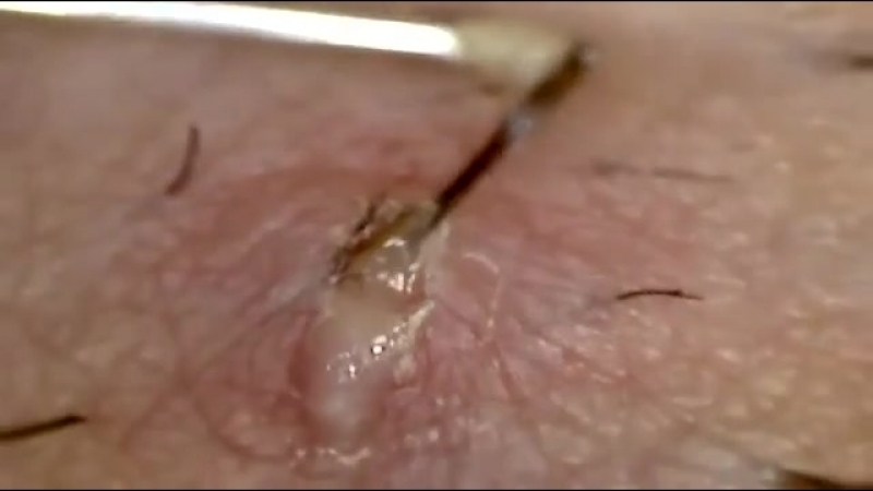 Удаление вросшего волоса