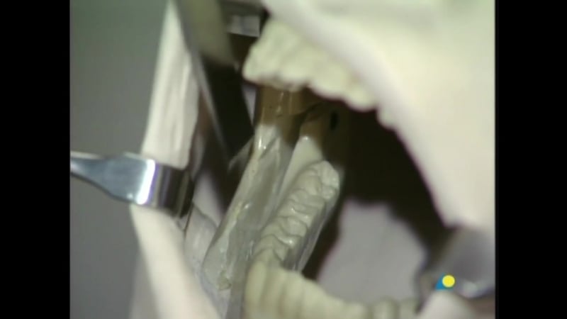 Репозиция челюстей в гнатической хирургии