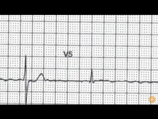 Ecg case 4 palpitations