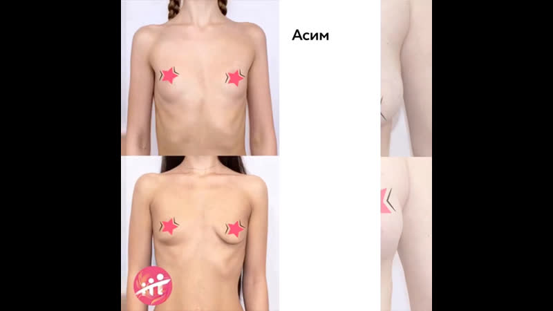 Коррекция асимметрии груди #маммопластика