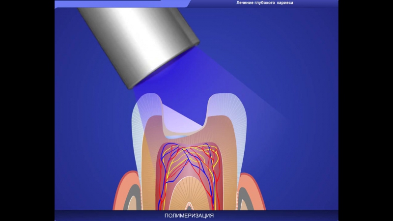 Глубокий кариес