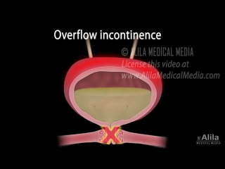 Urinary incontinence in women, //