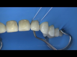 Advanced rubberdam isolation dam and veneers simple ligature