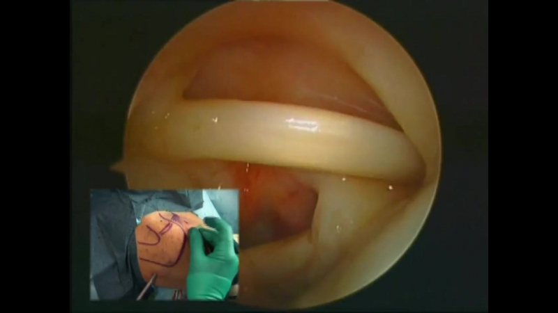 Инъекция в плечевой сустав переднебоковой доступ