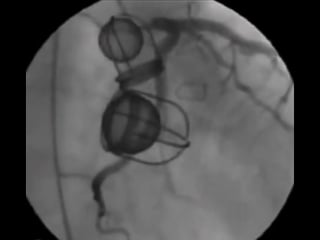 Работа искусственного клапана сердца