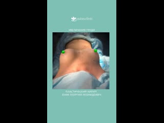 Увеличение груди в клинике «пульс» архангельск пластический хирург еник г л