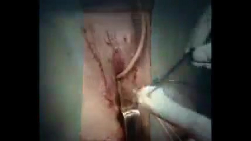 Operación de pene a vagina