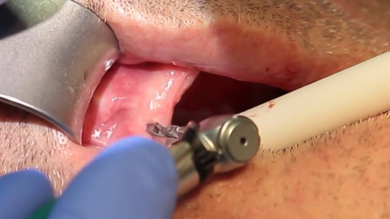 Репозиция фрагментов нижней челюсти, дентальная имплантация, пластика рубца, prp терапия