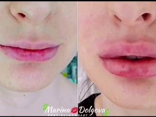 Пышные 💋 губки 😻 от марины долговой 👩🏻‍⚕️