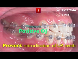 Correcting anterior crossbite for patients with extraction