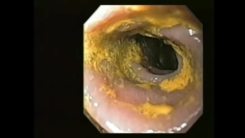 Колоноскопия кишечника видео очищение организма фортрансом от токсинов,глистов,домашнее лечение кандидоза подготоа к процедуре