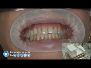 Professional oral hygiene dte pt5 acteon montecarotte (fhd multistream)