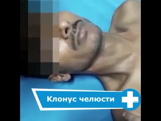 Клонус нижней челюсти