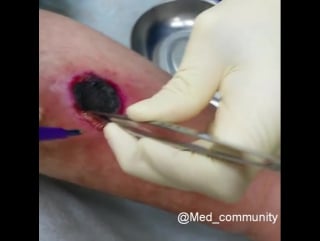 Удаление участка омертвершей ткани после ожога 4й степени