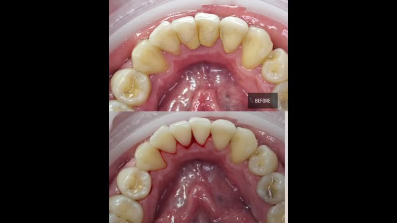 Больно! не нужная услуга! сначала кариес вылечу! ⠀ как часто слышим мы у новых пациентов утверждения, что профессиональная услуг