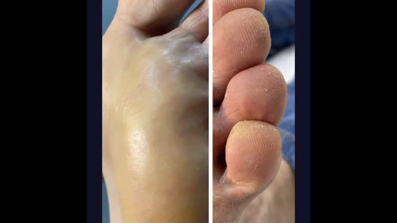 Аппаратный педикюр