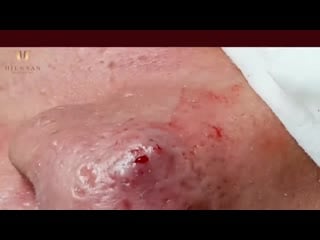 Вскрывание большого подкожного прыща на носу