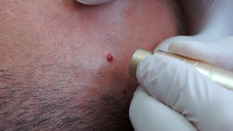 Лазерное удаление ангиомы на лбу