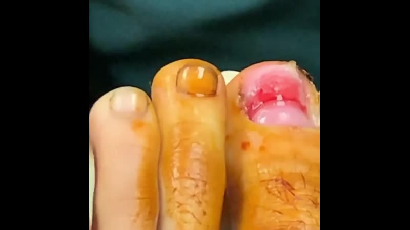 Удаление вросшего ногтя