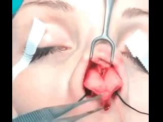 Ринопластика