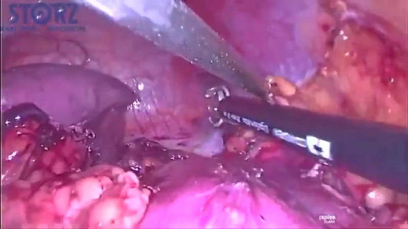 Резекция почки