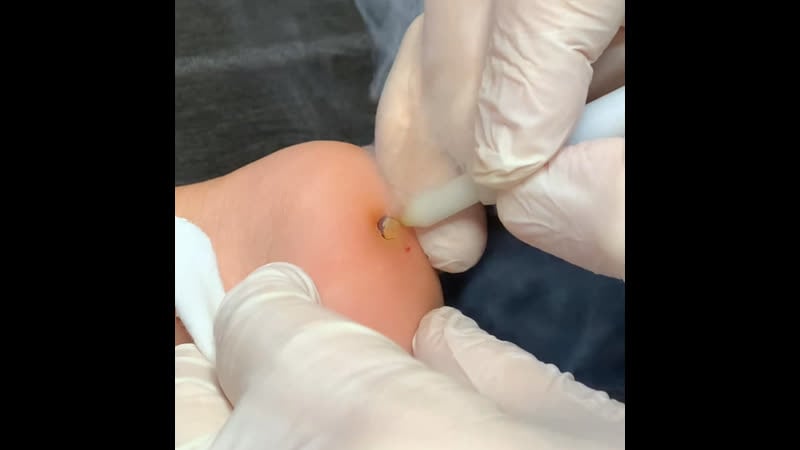 Удаление бородаи