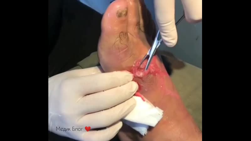 3 3 дренаж абсцесса с помощью скальпеля и корцанга