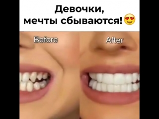 Perfect smile veneers дарят привлекательную белоснежную улыбку