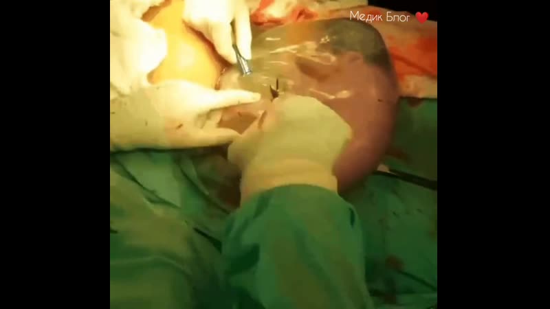 Амниотический мешок наполненная жидкостью полость между эмбрионом и амнионом