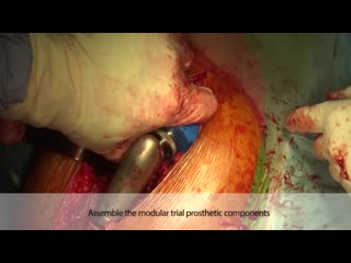Proximal femur resection and replacement